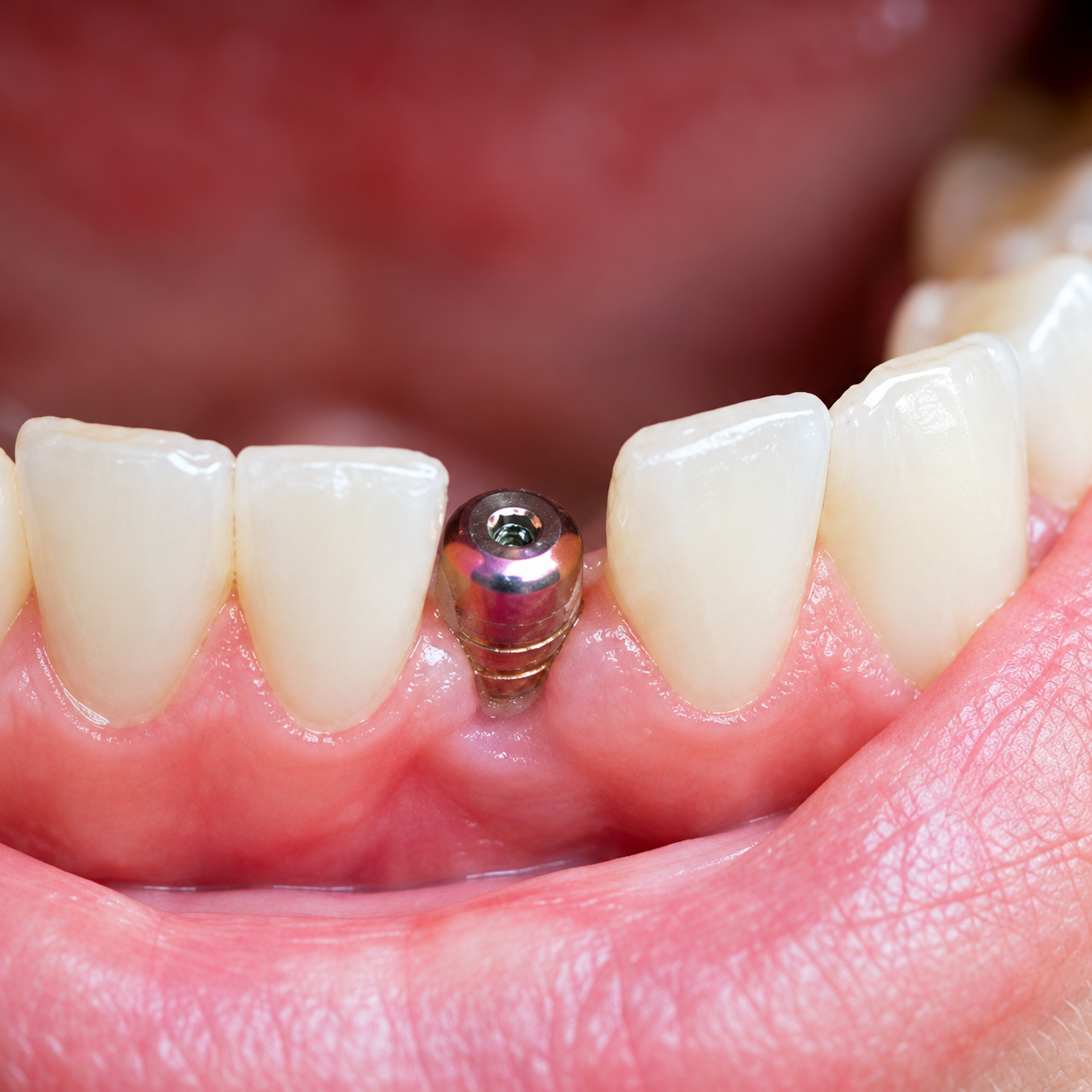 Dental implant abutment between natural teeth